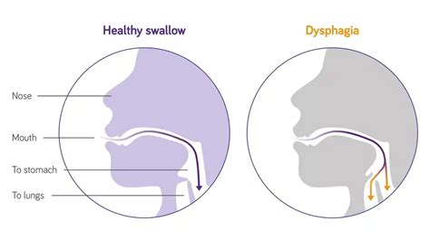 analphagia|Dysphagia .